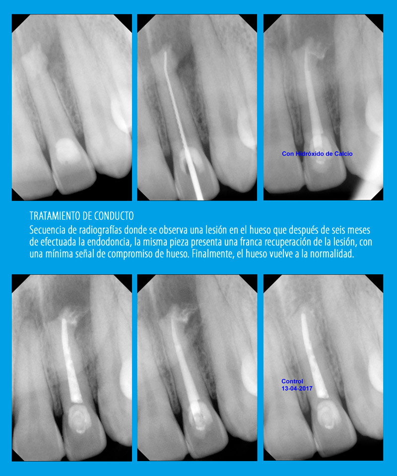 Evolución de un tratamiento de conducto