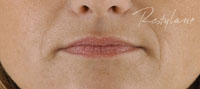 Antes